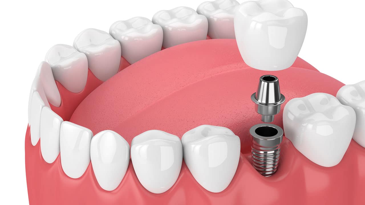periimplantitis