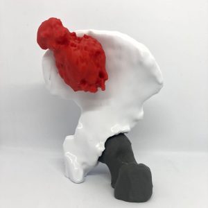 tumor en 3d tumor en 3d
