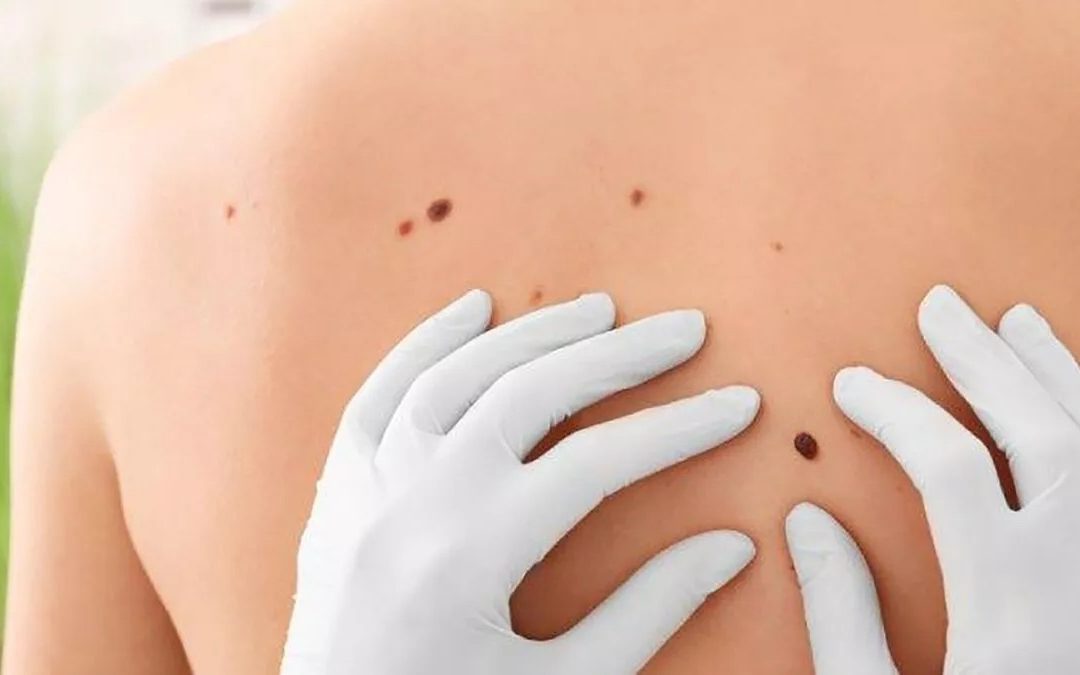 melanoma